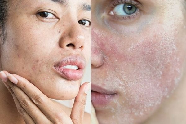 Những dấu hiệu cơ bản nhận biết da khô