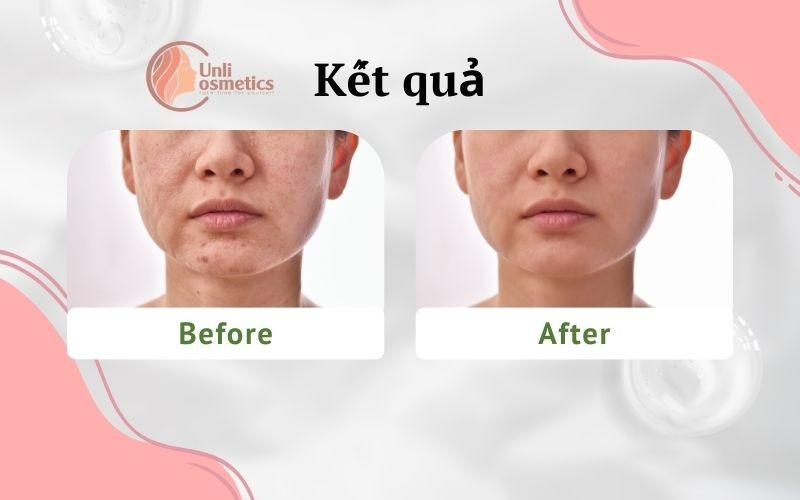 kết quả Kem chống nắng nâng tone KARADIUM Sun Snail Repair Suncream Spf50+ PA+++