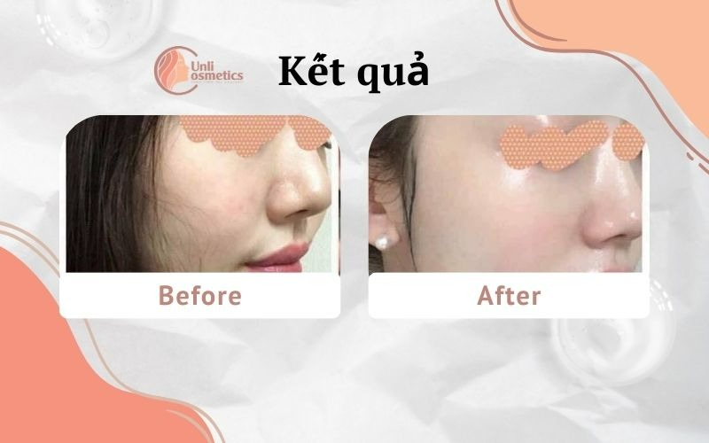 Kết quả khi sử dụng tinh chất The Ordinary AHA 30% BHA 2% Peeling Solution