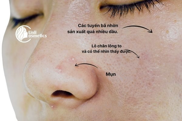 Dấu hiệu cơ bản nhận biết da dầu
