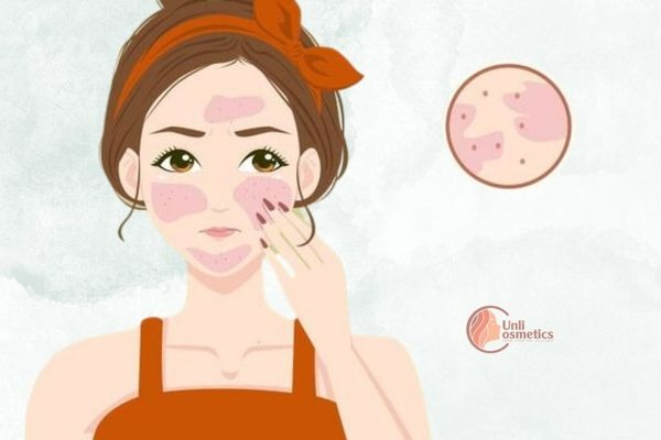 Cách nhận biết da nhạy cảm